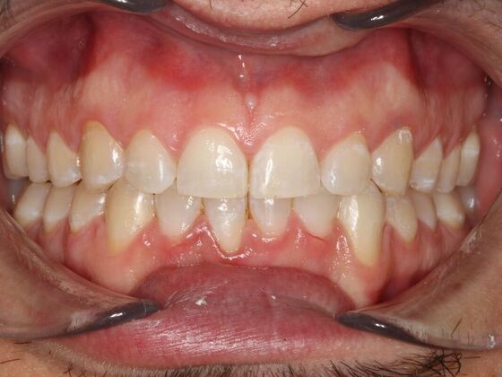 Invisalign Case 23 - After