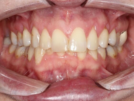 Invisalign Case 24 - Before