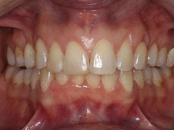 Invisalign Case 24 - After