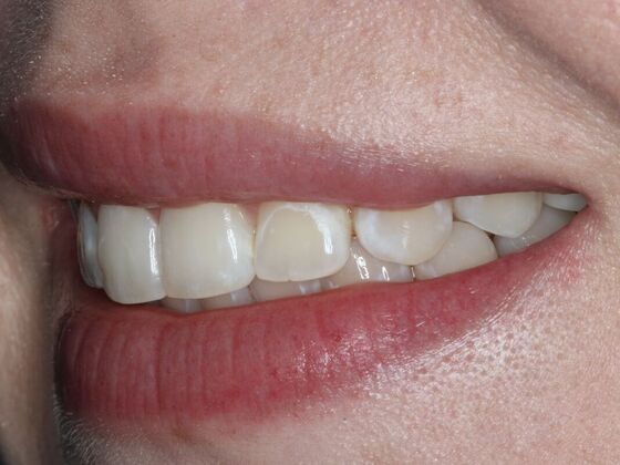 Porcelain Veneers Case 3 - Before