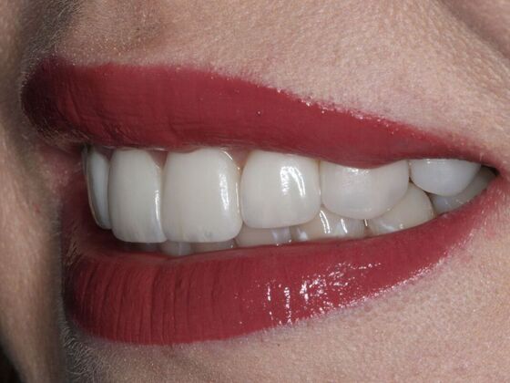 Porcelain Veneers Case 3 - After