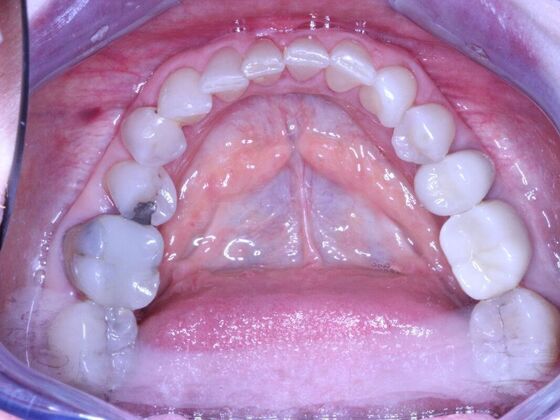 Invisalign Case 25 - Before