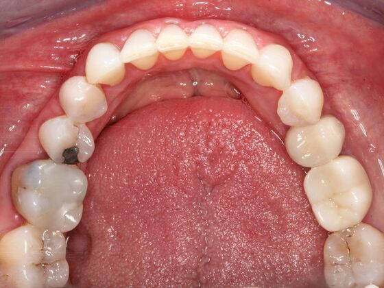 Invisalign Case 25 - After