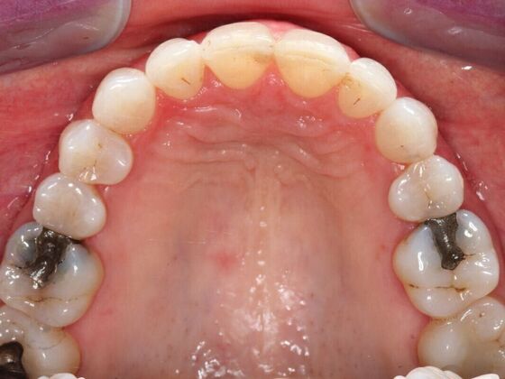 Invisalign Case 26 - After