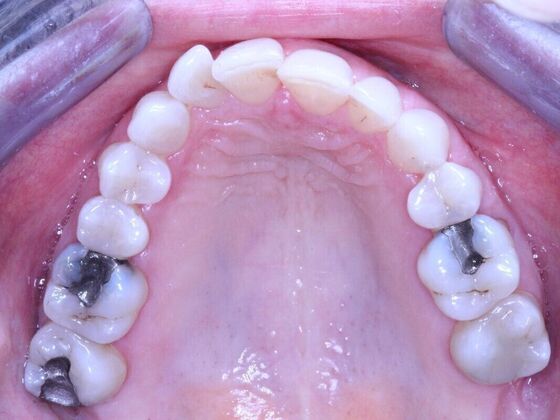 Invisalign Case 26 - Before