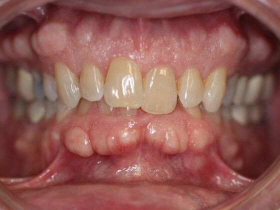 Invisalign Case 27 - Before