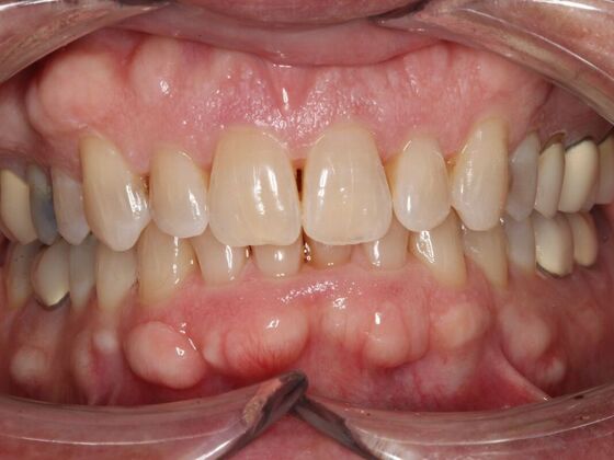 Invisalign Case 27 - After