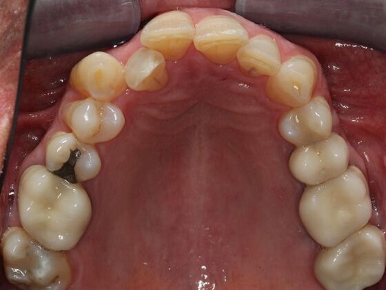 Invisalign Case 28 - Before
