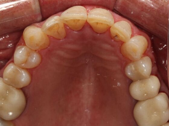 Invisalign Case 28 - After