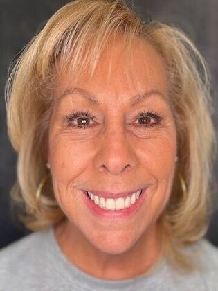 All on 4 Dental Implants: Case 17 - After