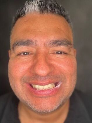 All on 4 Dental Implants: Case 18 - Before