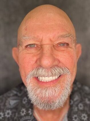 All on 4 Dental Implants: Case 19 - After