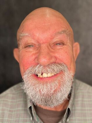 All on 4 Dental Implants: Case 19 - Before