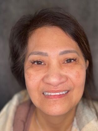 All on 4 Dental Implants: Case 20 - After