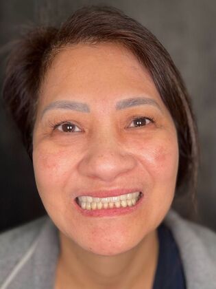 All on 4 Dental Implants: Case 20 - Before