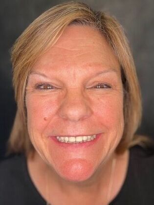 All on 4 Dental Implants: Case 21 - Before