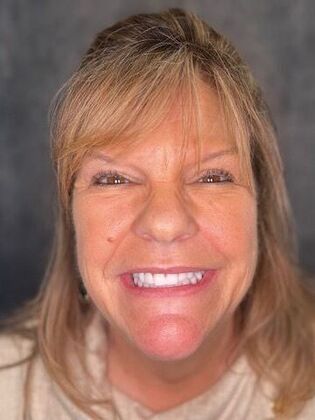 All on 4 Dental Implants: Case 21 - After