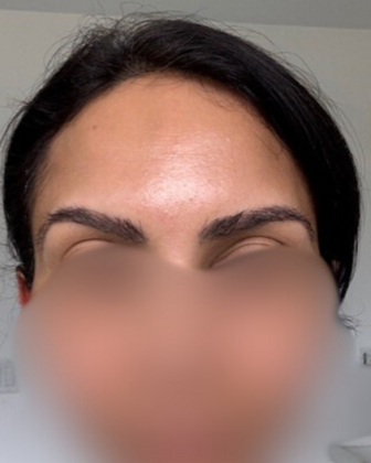 Eyebrow Transplant Case 1 - Eyebrow Transplant Restoration - After