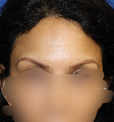 Eyebrow Transplant Case 1 - Eyebrow Transplant Restoration - Before