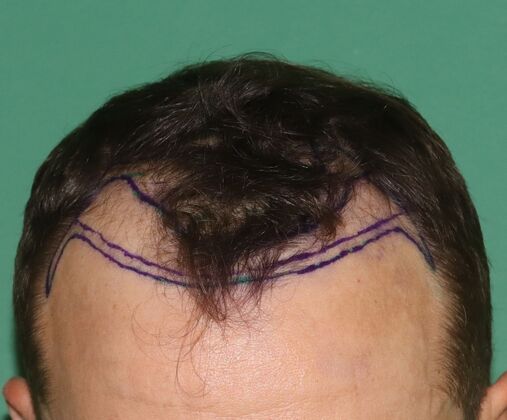 Hair Transplants Case 1 - Frontal Hairline Restoration - Before