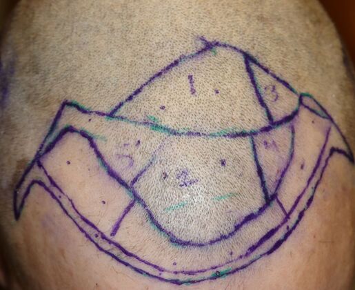 Hair Transplants: Case 1 - Frontal Hairline Restoration - Pre-Op Surgical Planning