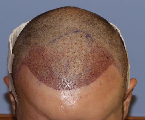 Hair Transplants: Case 1 - Frontal Hairline Restoration - Post-Op Day 1