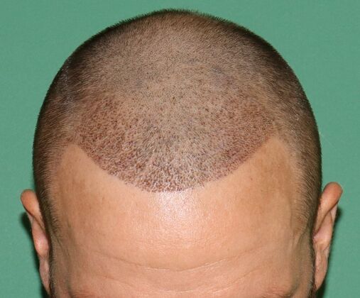 Hair Transplants: Case 1 - Frontal Hairline Restoration - Post-Op Day 5