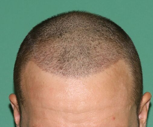 Hair Transplants: Case 1 - Frontal Hairline Restoration - Post-Op Day 14