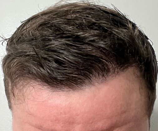 Hair Transplants Case 1 - Frontal Hairline Restoration - After