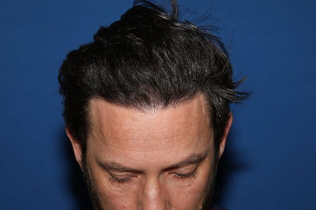 Hair Transplants Case 2 - Hairline Repair and Transplant - After