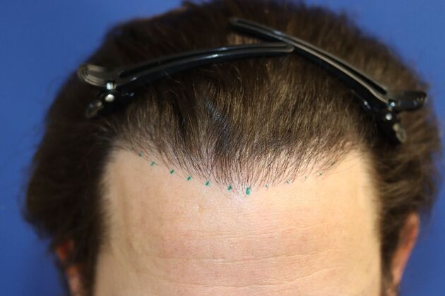 Hair Transplants Case 2 - Hairline Repair and Transplant - Before