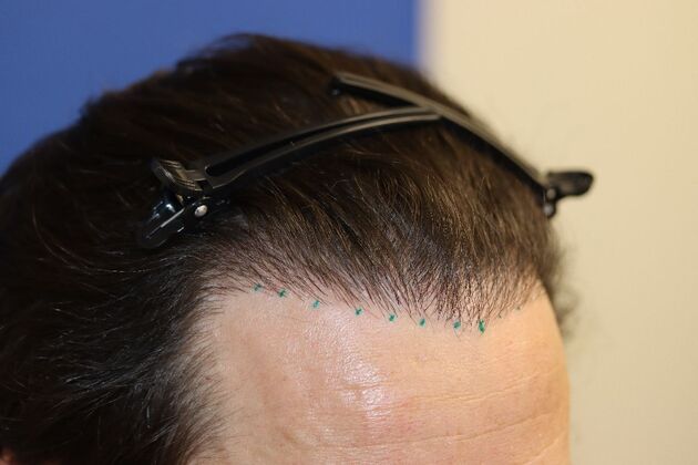 Hair Transplants: Case 2 - Hairline Repair and Transplant - Before