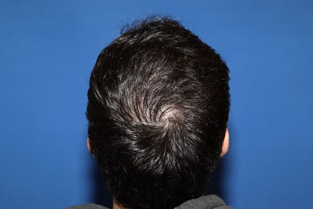 Hair Transplants: Case 3 - Crown Hair Restoration - After