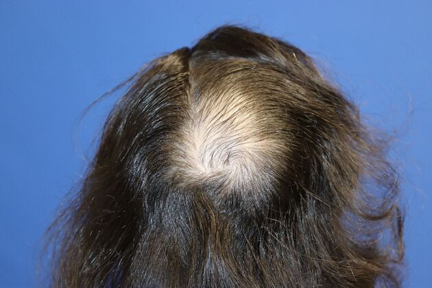 Hair Transplants: Case 3 - Crown Hair Restoration - Before