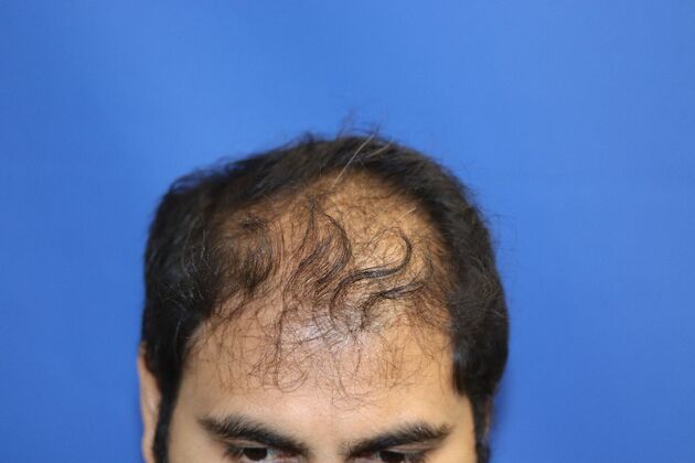 Hair Transplants: Case 4 - Beard and Scalp FUE Hair Transplant - Before