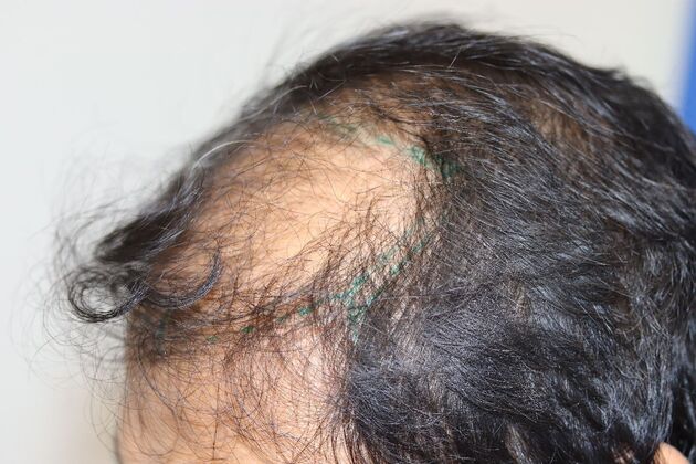 Hair Transplants: Case 4 - Beard and Scalp FUE Hair Transplant - Before