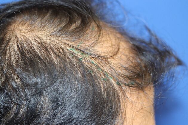Hair Transplants: Case 4 - Beard and Scalp FUE Hair Transplant - Before