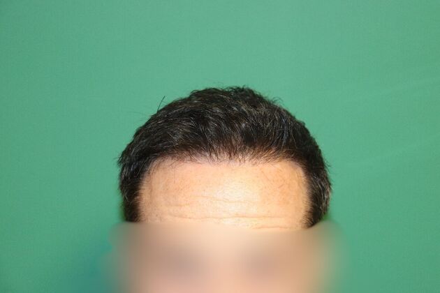 Hair Transplants: Case 5 - Frontal and Midscalp Hair Restoration - Before