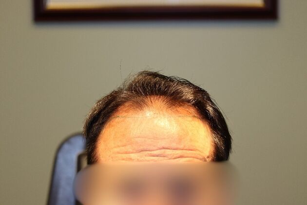 Hair Transplants: Case 5 - Frontal and Midscalp Hair Restoration - After