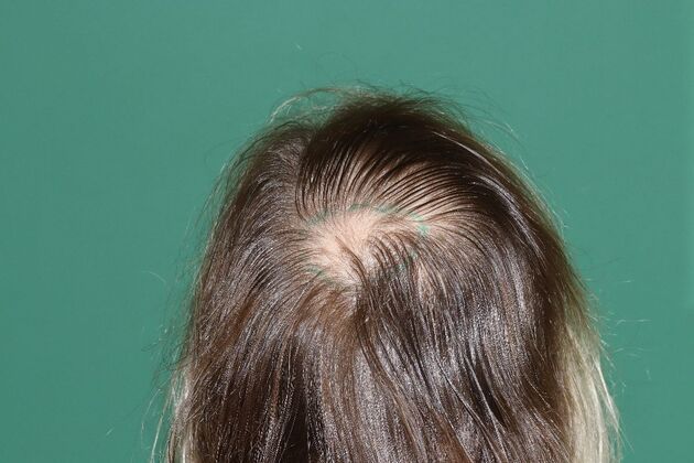 Hair Transplants: Case 6 - Crown Restoration - Pre-Op