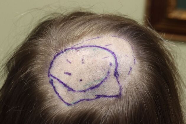 Hair Transplants: Case 6 - Crown Restoration - Pre-Op with Surgical Planning