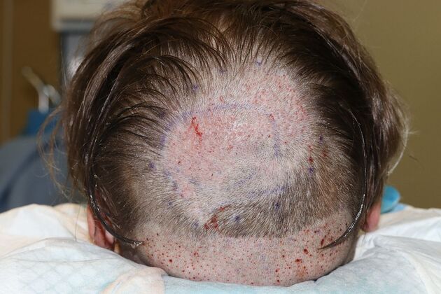 Hair Transplants: Case 6 - Crown Restoration - Immediate Post-Op