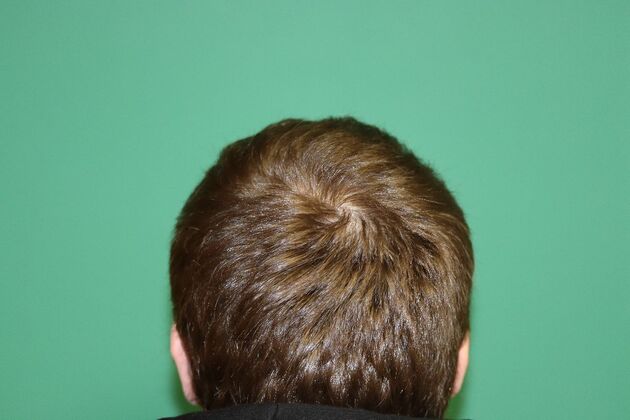 Hair Transplants: Case 6 - Crown Restoration - 9 Month Result