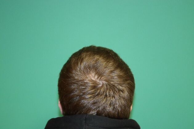 Hair Transplants: Case 6 - Crown Restoration - 9 Month Result