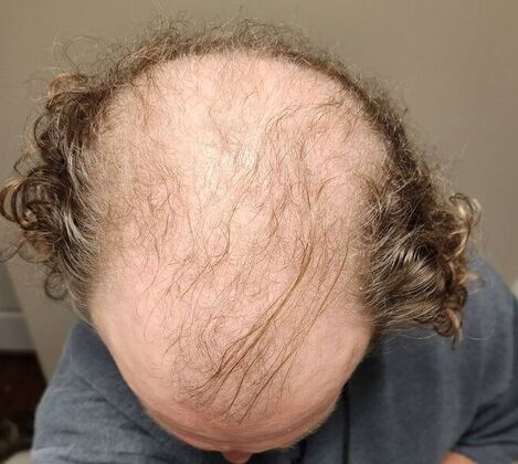 Hair Transplants: Case 7 - Hairline and Midscalp Restoration - Pre-Op