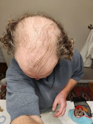 Hair Transplants: Case 7 - Hairline and Midscalp Restoration - Pre-Op