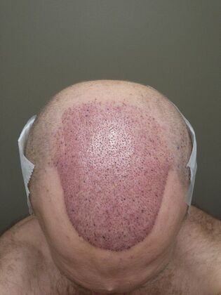 Hair Transplants: Case 7 - Hairline and Midscalp Restoration - Immediate Post-Op