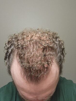 Hair Transplants: Case 7 - Hairline and Midscalp Restoration - 12 Month Result