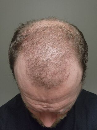 Hair Transplants: Case 7 - Hairline and Midscalp Restoration - 4 Month Result