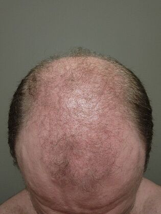 Hair Transplants: Case 7 - Hairline and Midscalp Restoration - 3 Month Result